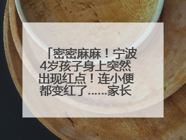 密密麻麻！宁波4岁孩子身上突然出现红点！连小便都变红了……家长：以为只是摔伤